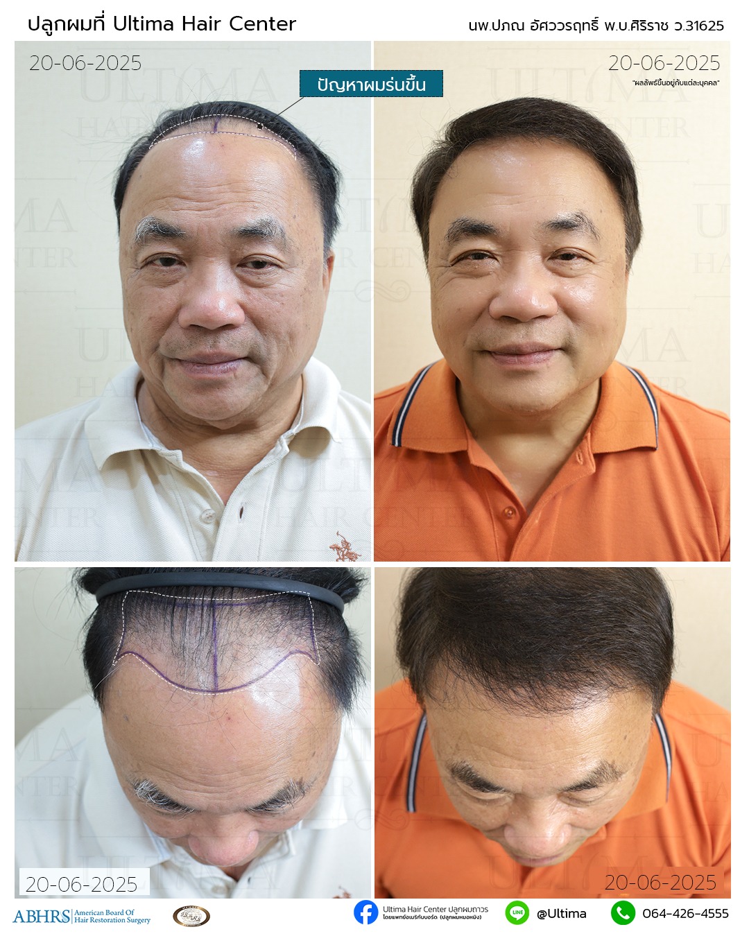 คืนความมั่นใจ บอกลาศีรษะล้าน