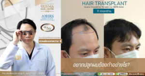 เราสามารถปลูกผมได้กี่ครั้ง