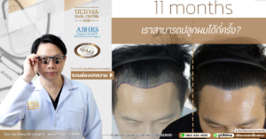 เราสามารถปลูกผมได้กี่ครั้ง