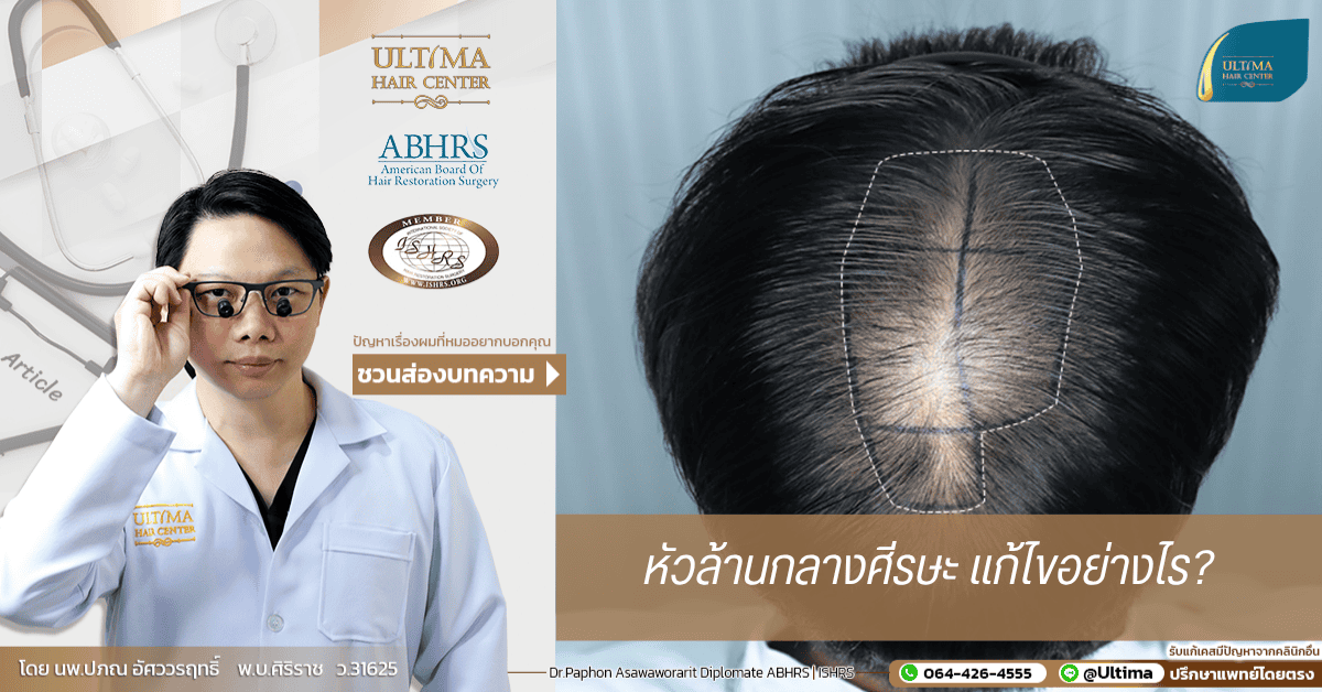 หัวล้านกลางศีรษะ แก้ไขอย่างไร