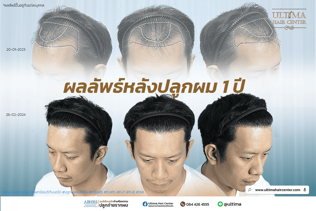 คนเรามีผมทั้งหมดกี่เส้น