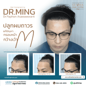 ปลูกผม