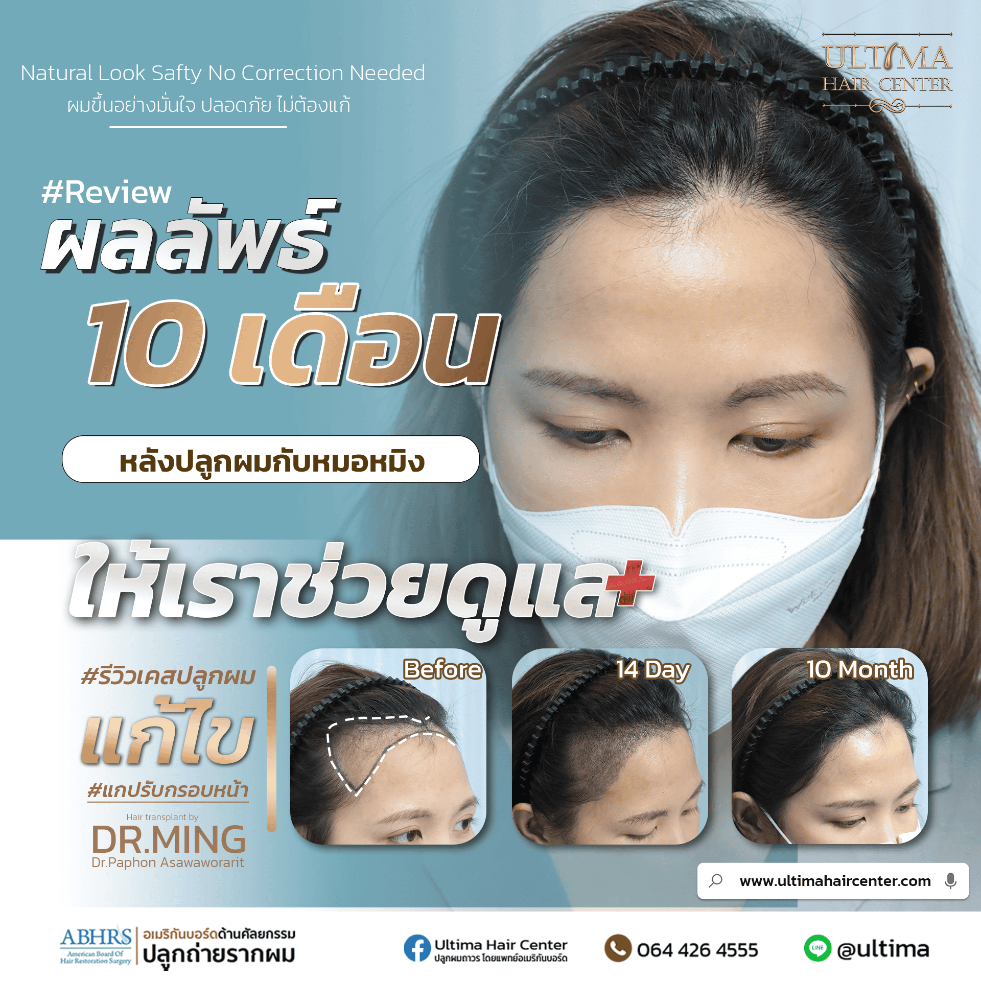 ปลูกผมผู้หญิง
