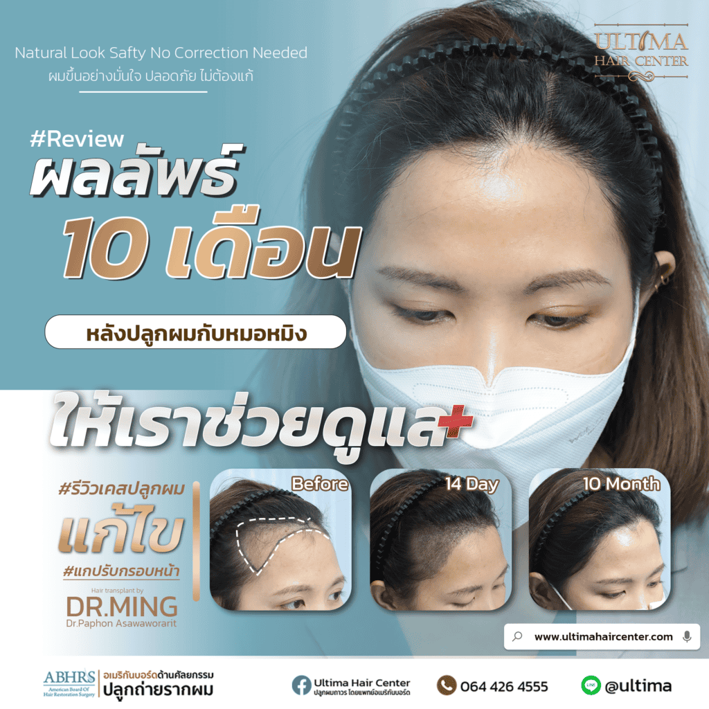 ปลูกผมในผู้หญิงสามารถทำส่วนใดได้บ้าง