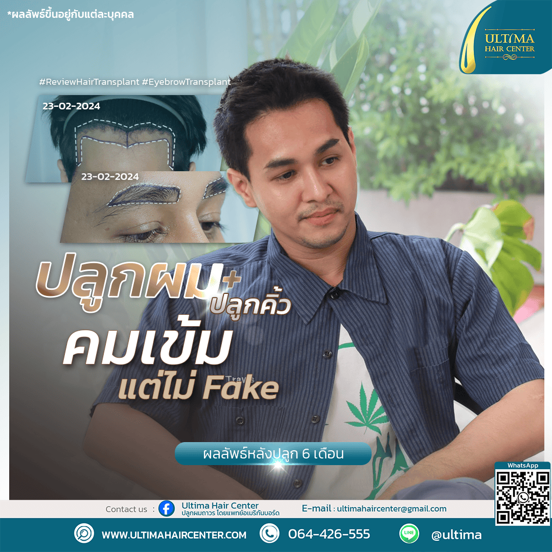ปลูกผม