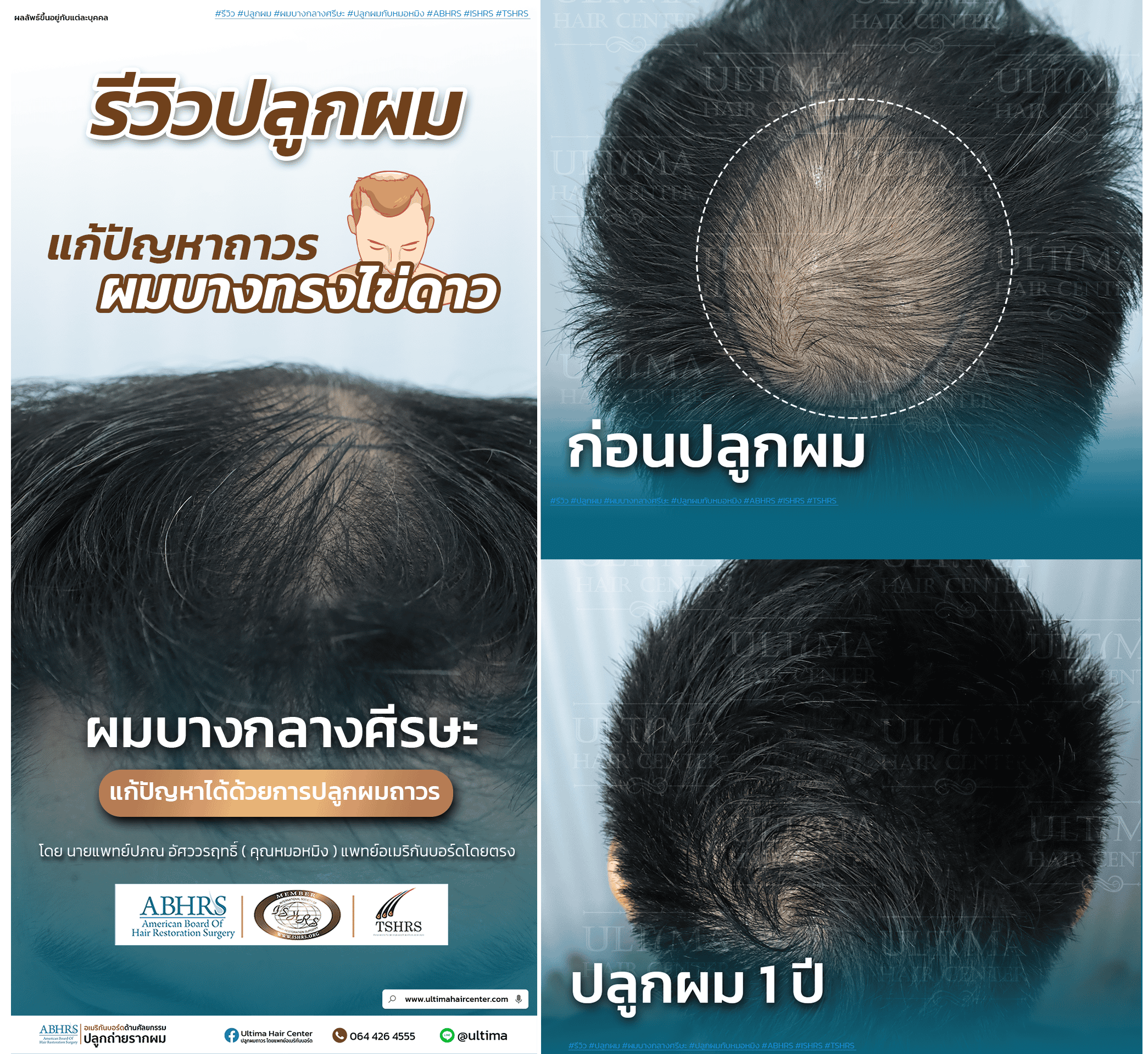 ผมร่วงเป็นหย่อม (Alopecia Areata) คืออะไร