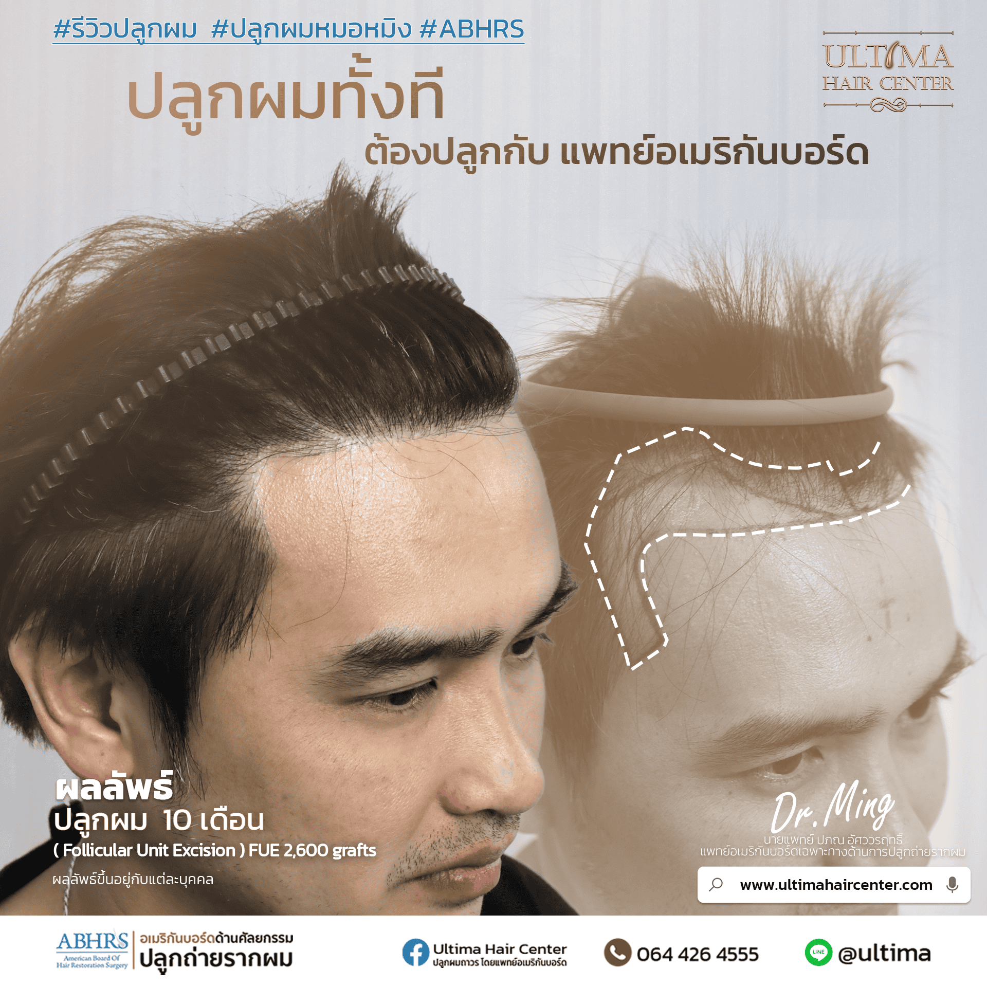ผมร่วงคืออะไร
