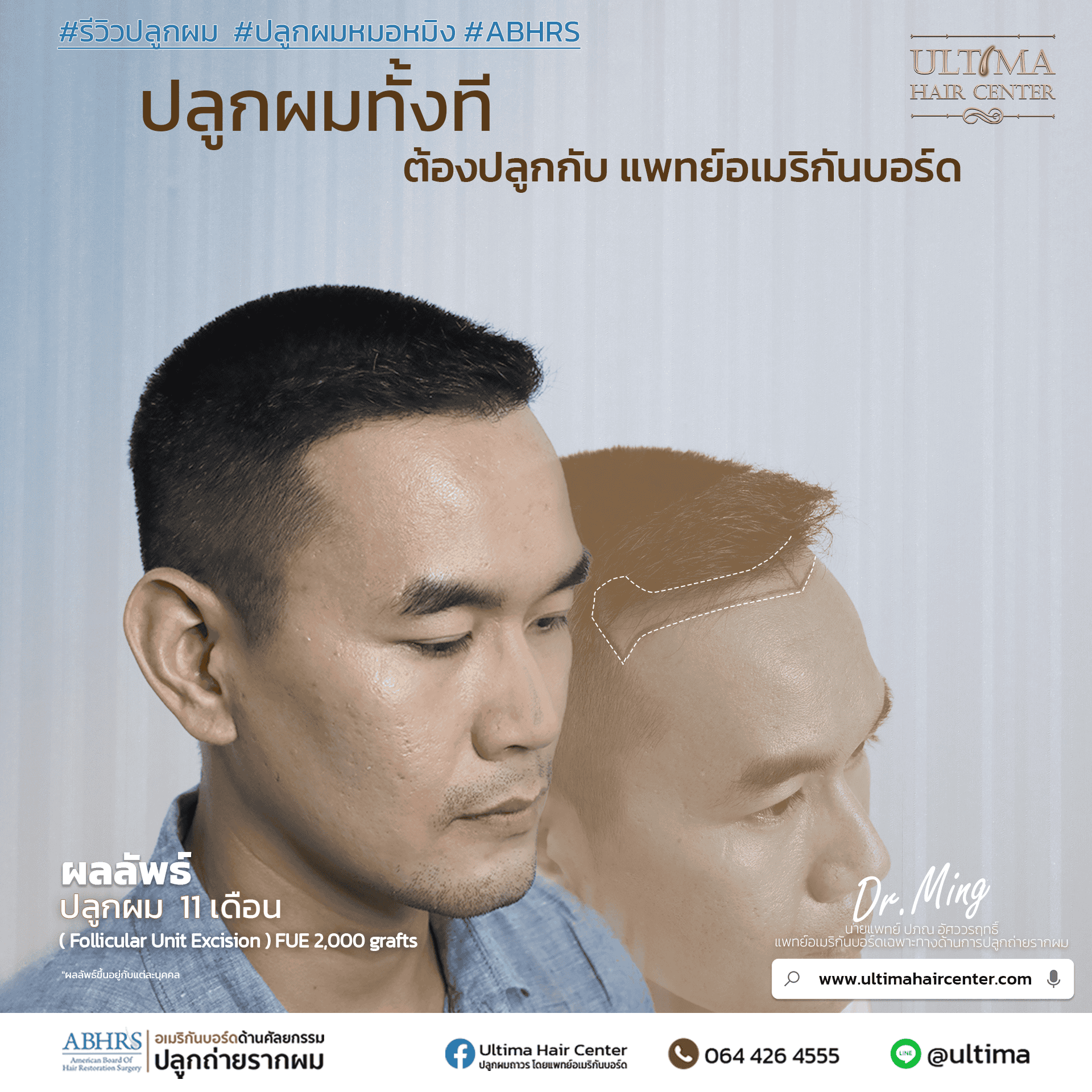 ผมร่วงคืออะไร