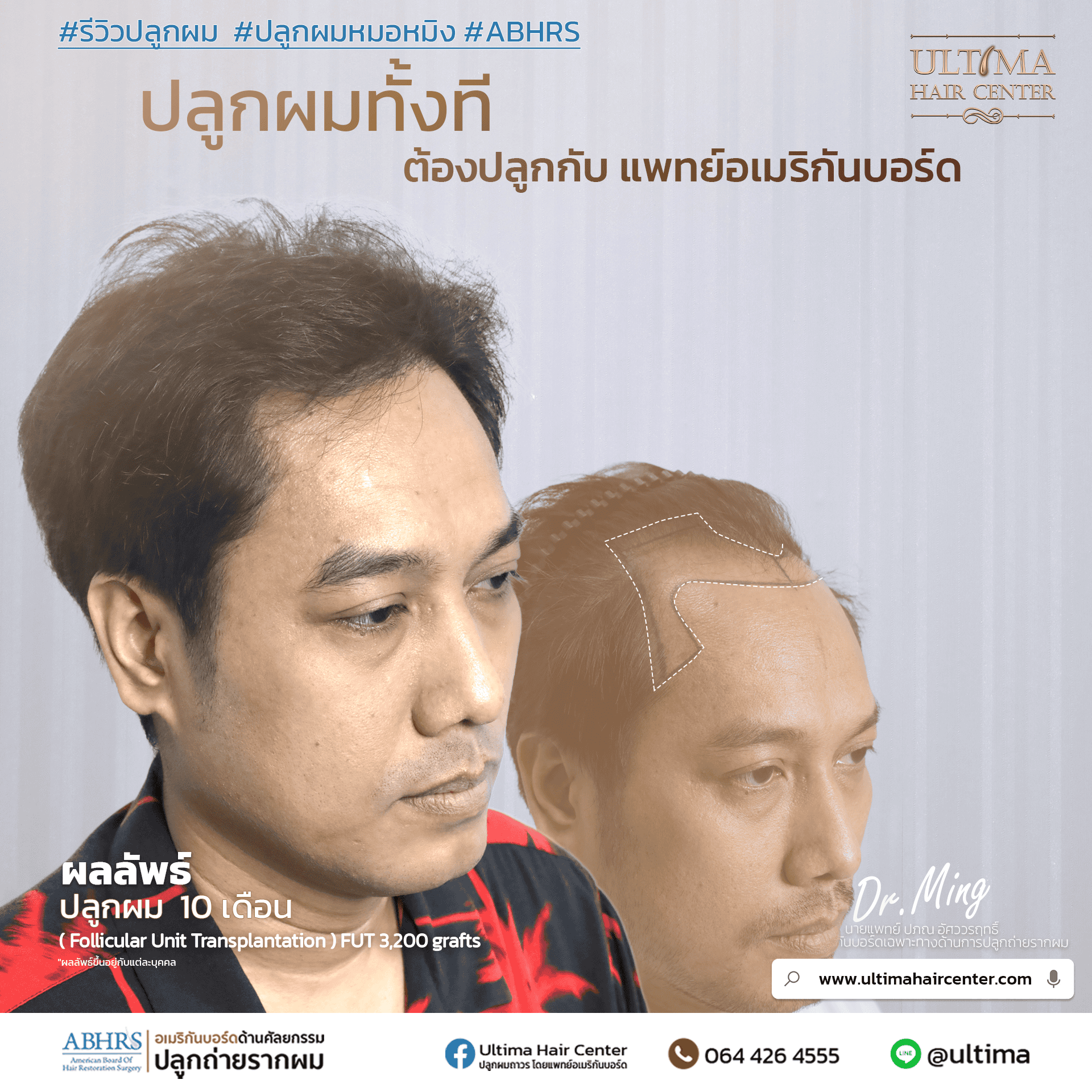 ผมร่วงคืออะไร