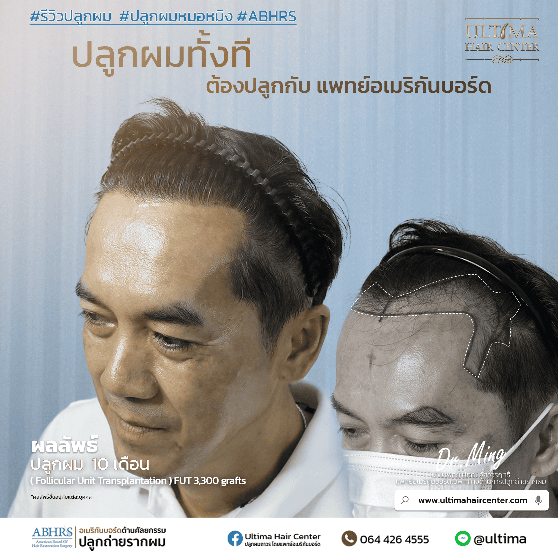 ผมร่วงคืออะไร