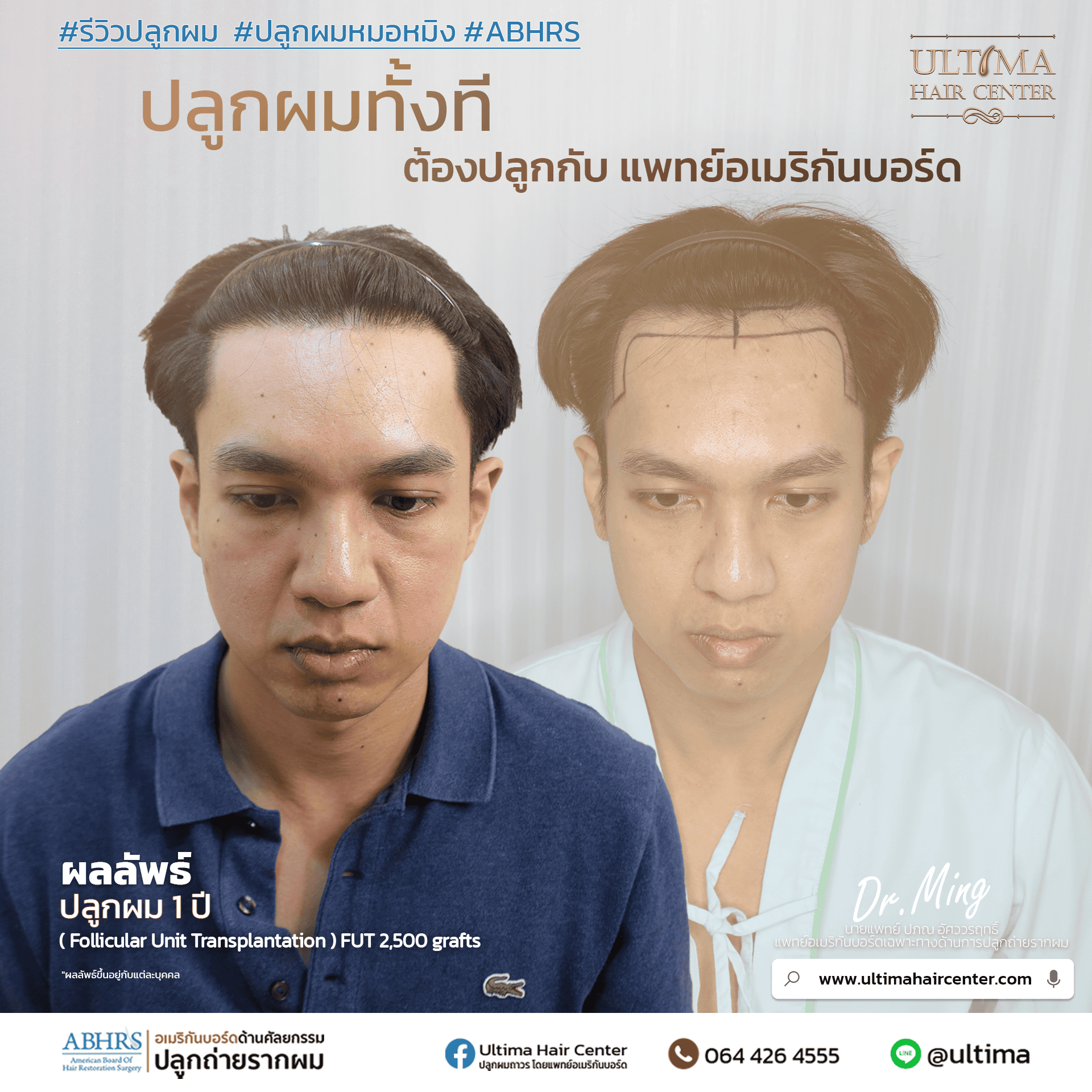 ผมร่วงคืออะไร