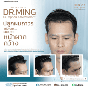 ปลูกผม