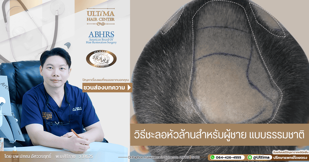 วิธีชะลอหัวล้านสำหรับผู้ชาย แบบธรรมชาติ วิธีชะลอหัวล้านสำหรับผู้ชาย แบบธรรมชาติ