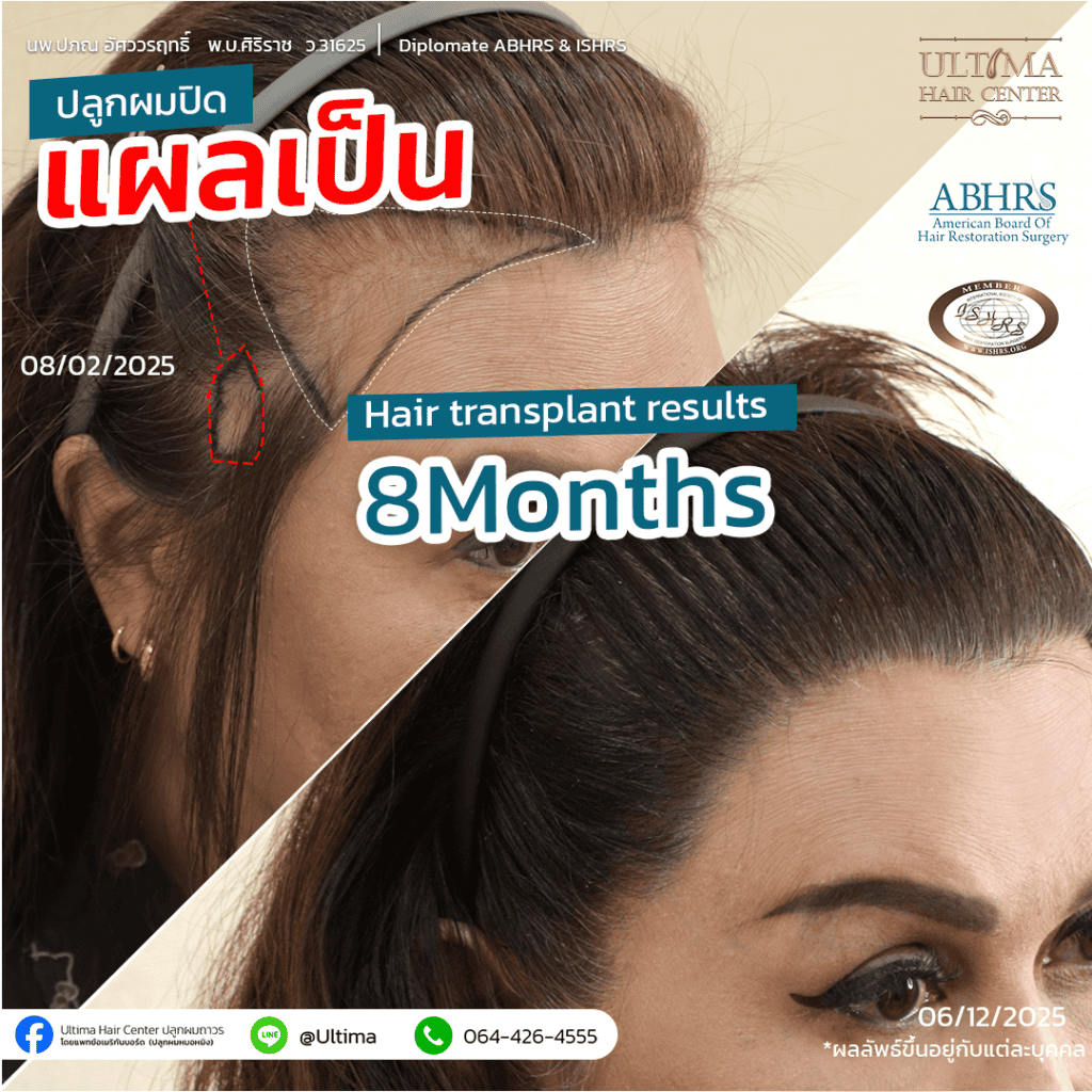 ปลูกผม