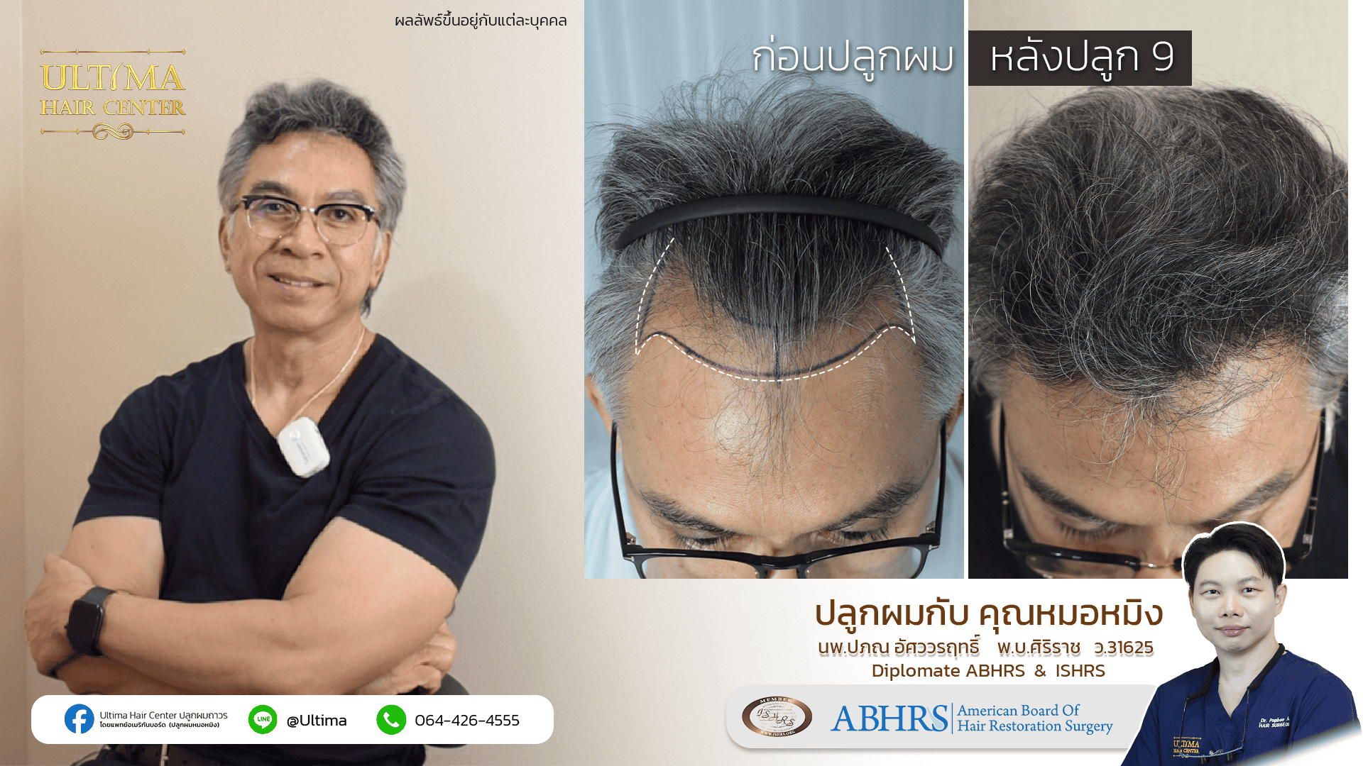 ปลูกผมในผู้ชายสามารถทำส่วนใดได้บ้าง