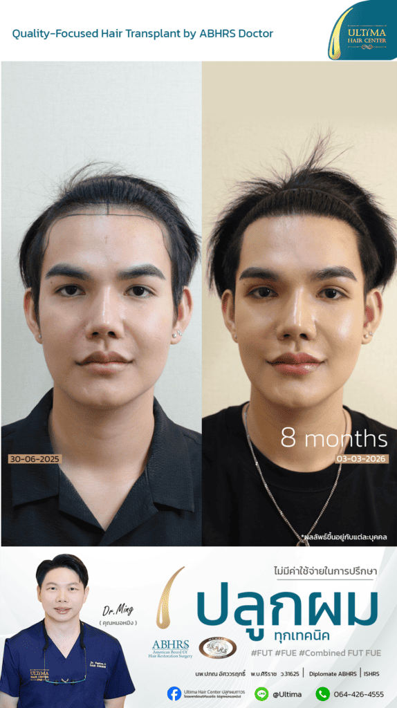 ปลูกผมได้ประโยชน์อย่างไร