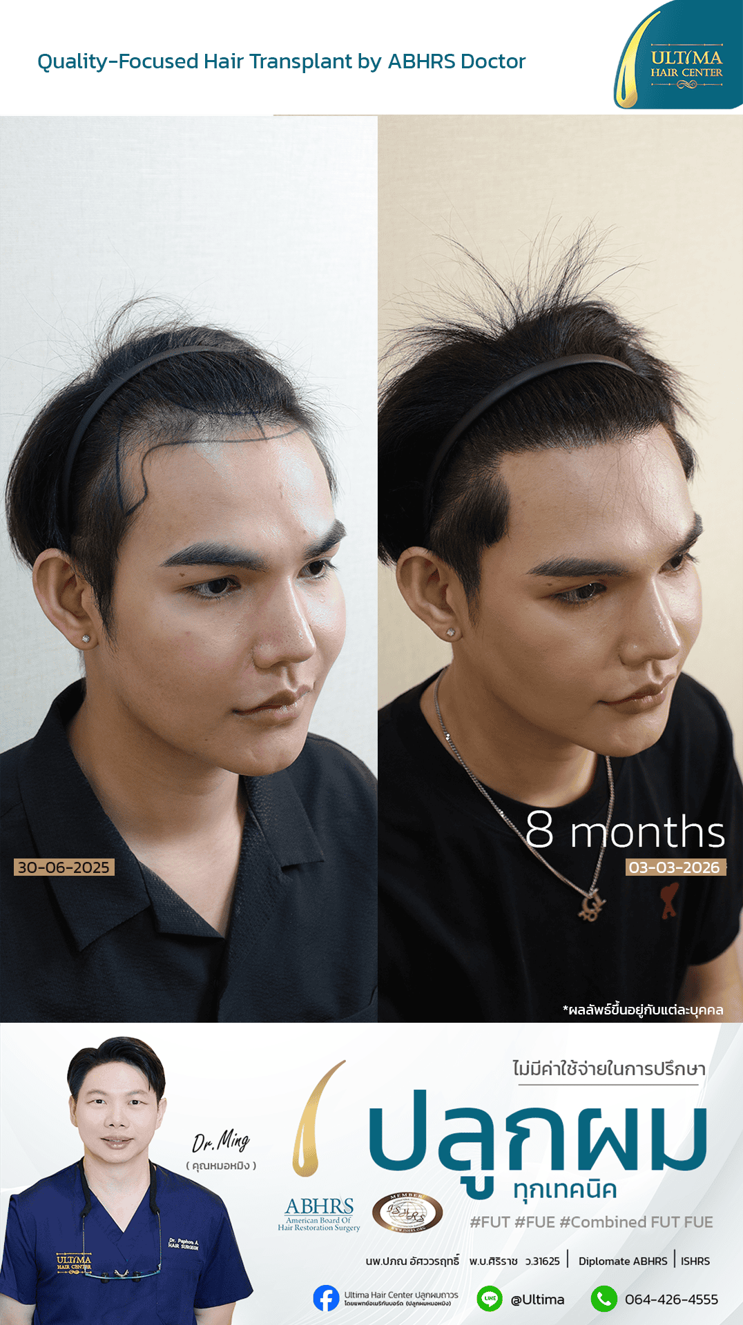 ปลูกผมได้ประโยชน์อย่างไร