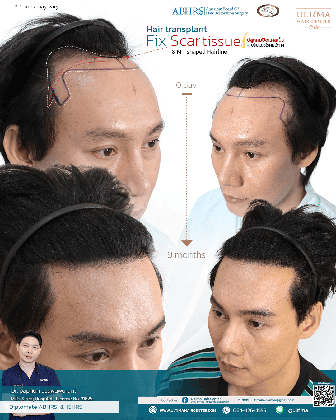ปลูกผมได้ประโยชน์อย่างไร