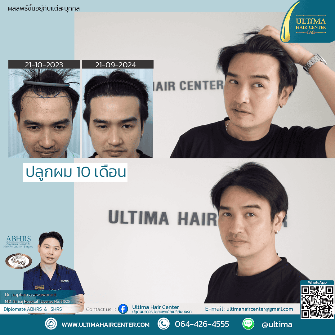 ปลูกผม FUE