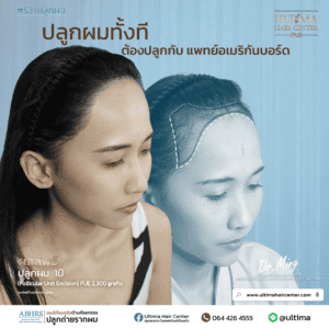 ปลูกผม