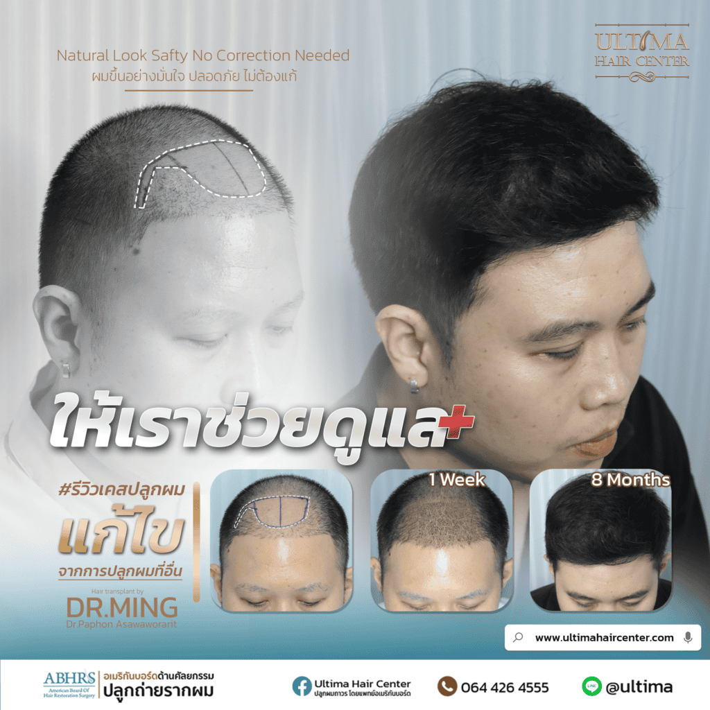 ปลูกผมโซนบางกะปิ กรุงเทพกรีฑา เลือกคลินิกอย่างไร