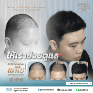 ปลูกผม