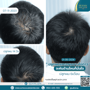 ปลูกผม