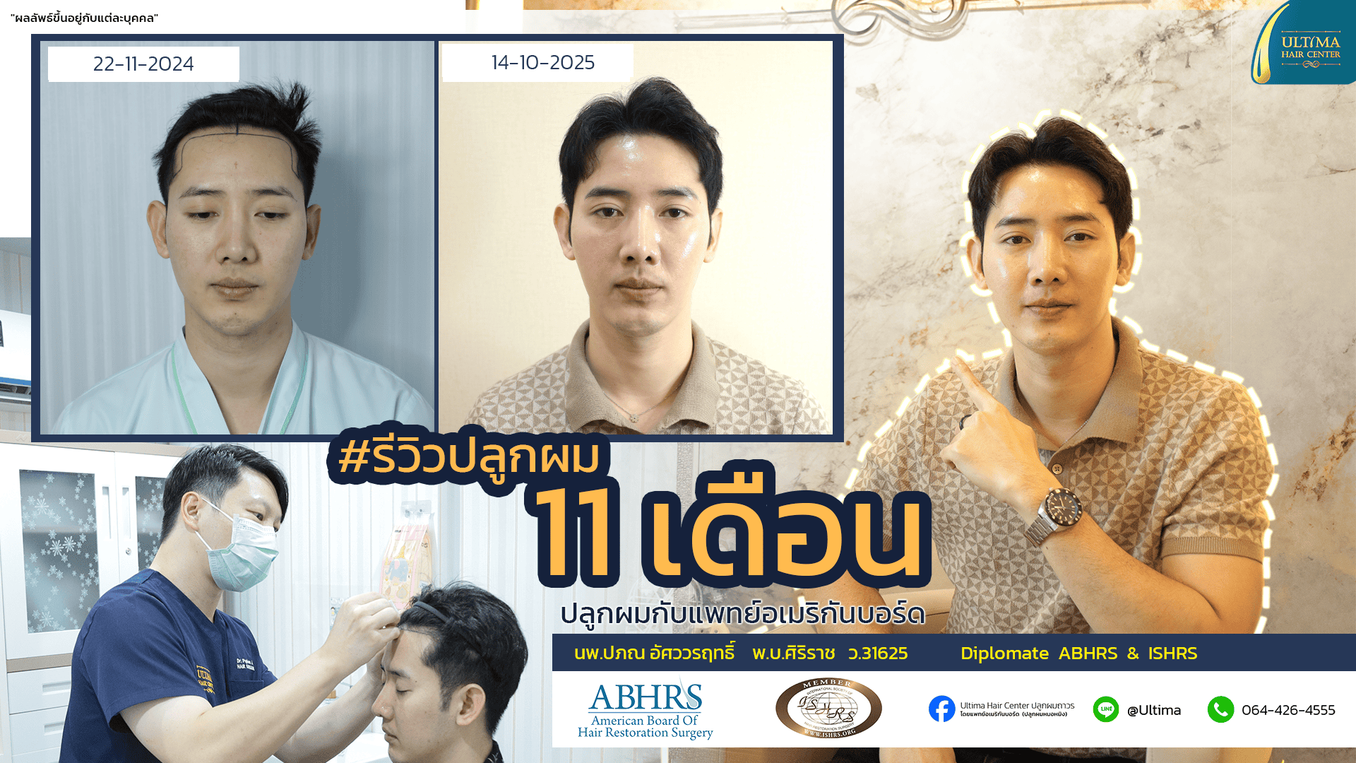 ปลูกผมได้ประโยชน์อย่างไร