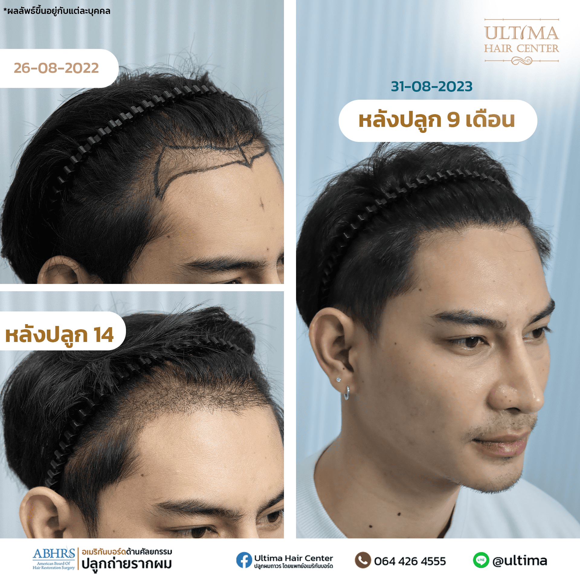 ผมร่วงคืออะไร