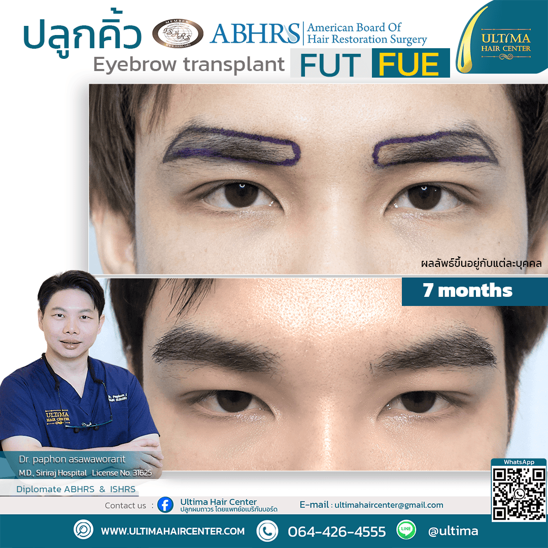 ปลูกคิ้วแล้วคิ้วจะดูเป็นธรรมชาติแค่ไหน