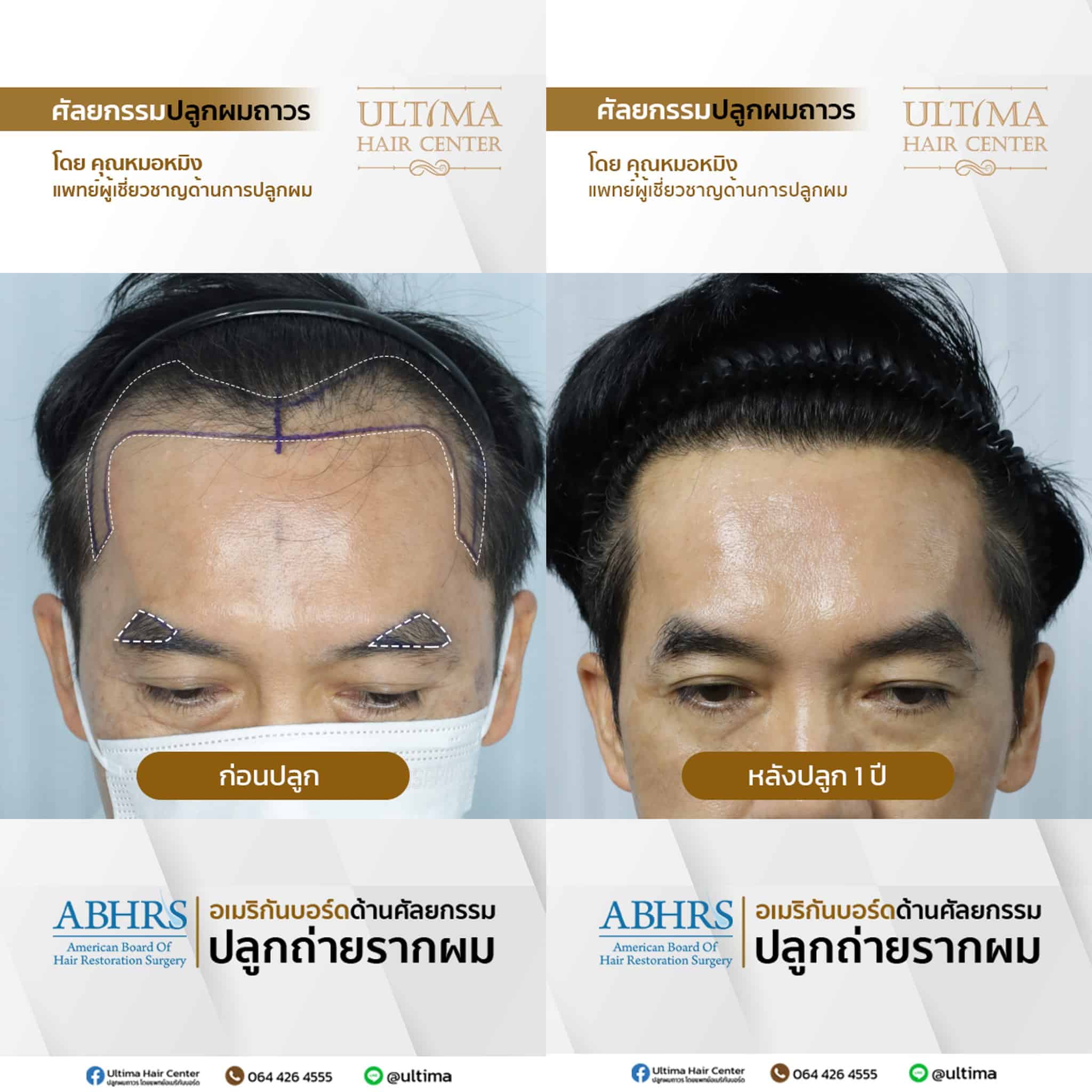 ปลูกคิ้วแล้วสามารถโกนได้ไหม