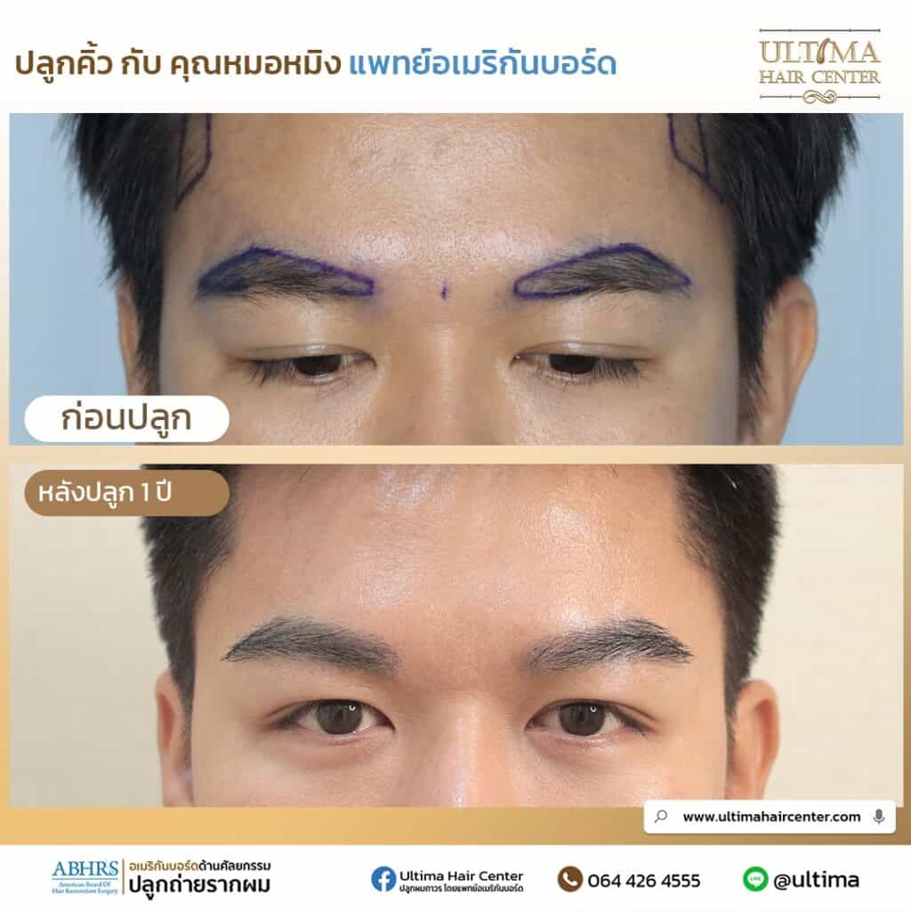 ปลูกคิ้วแล้วมีโอกาสไม่สำเร็จไหม