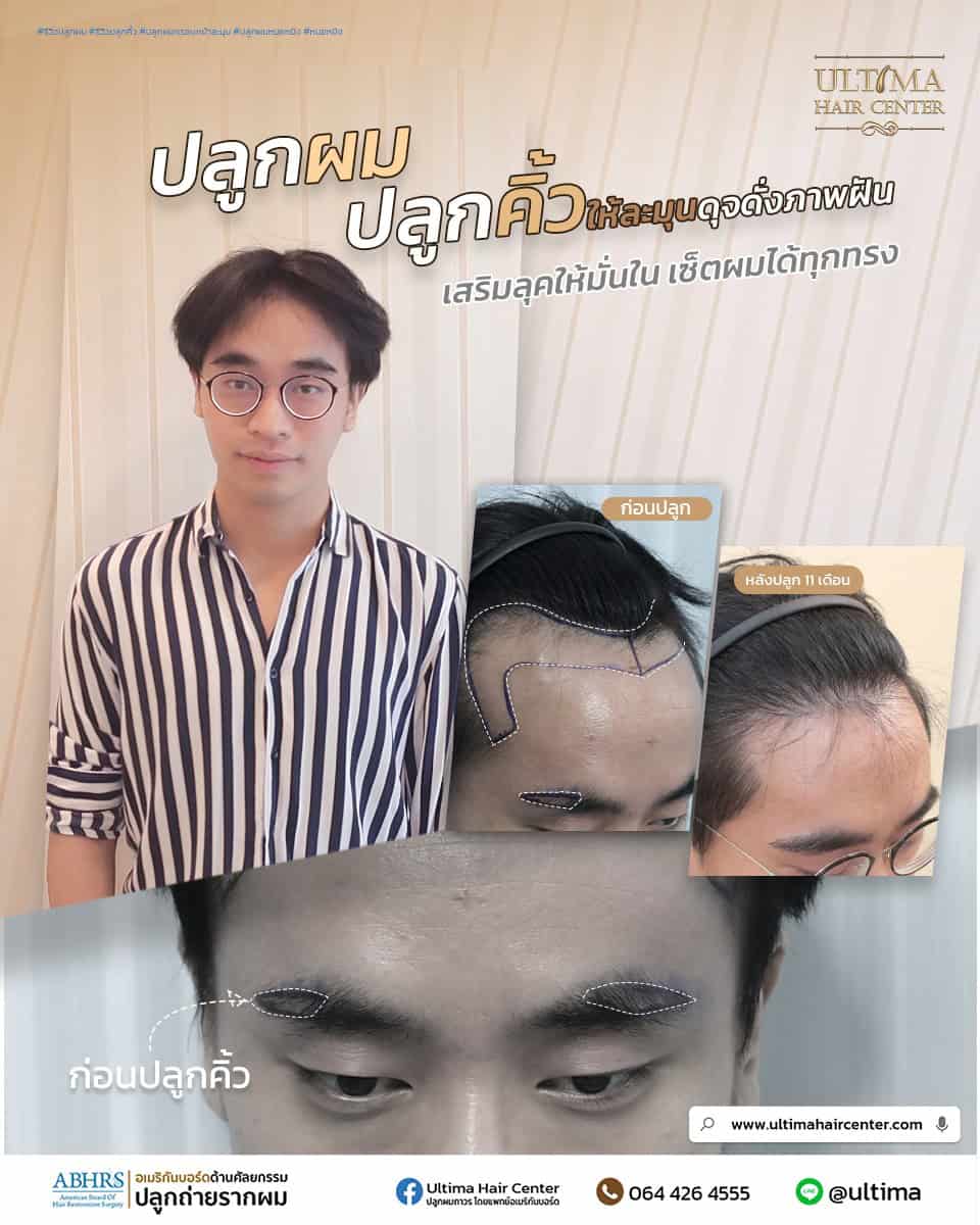 ปลูกคิ้วแล้วสามารถโกนได้ไหม