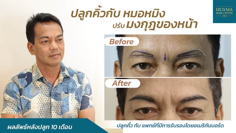 ปลูกคิ้ว