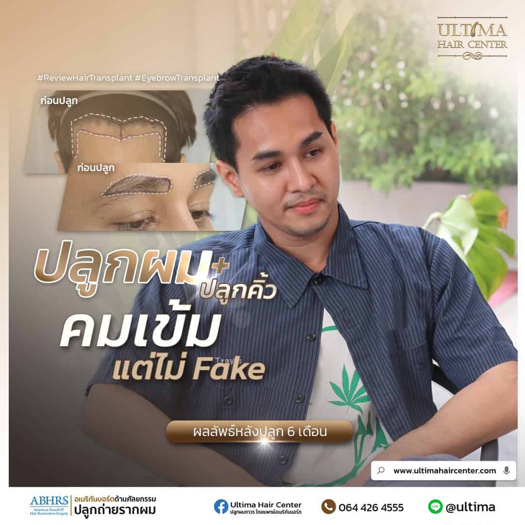 ปลูกผม