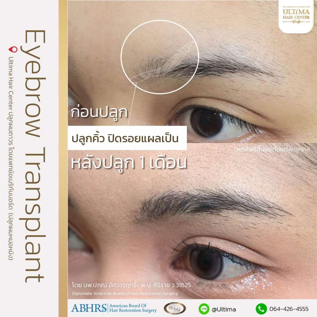 ปลูกคิ้ว