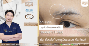 ปลูกคิ้วแล้วสามารถโกนได้ไหม