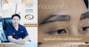 ปลูกคิ้วแล้วมีโอกาสไม่สำเร็จไหม