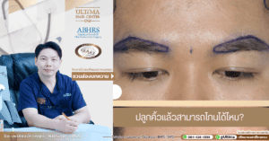 ปลูกคิ้วแล้วสามารถโกนได้ไหม