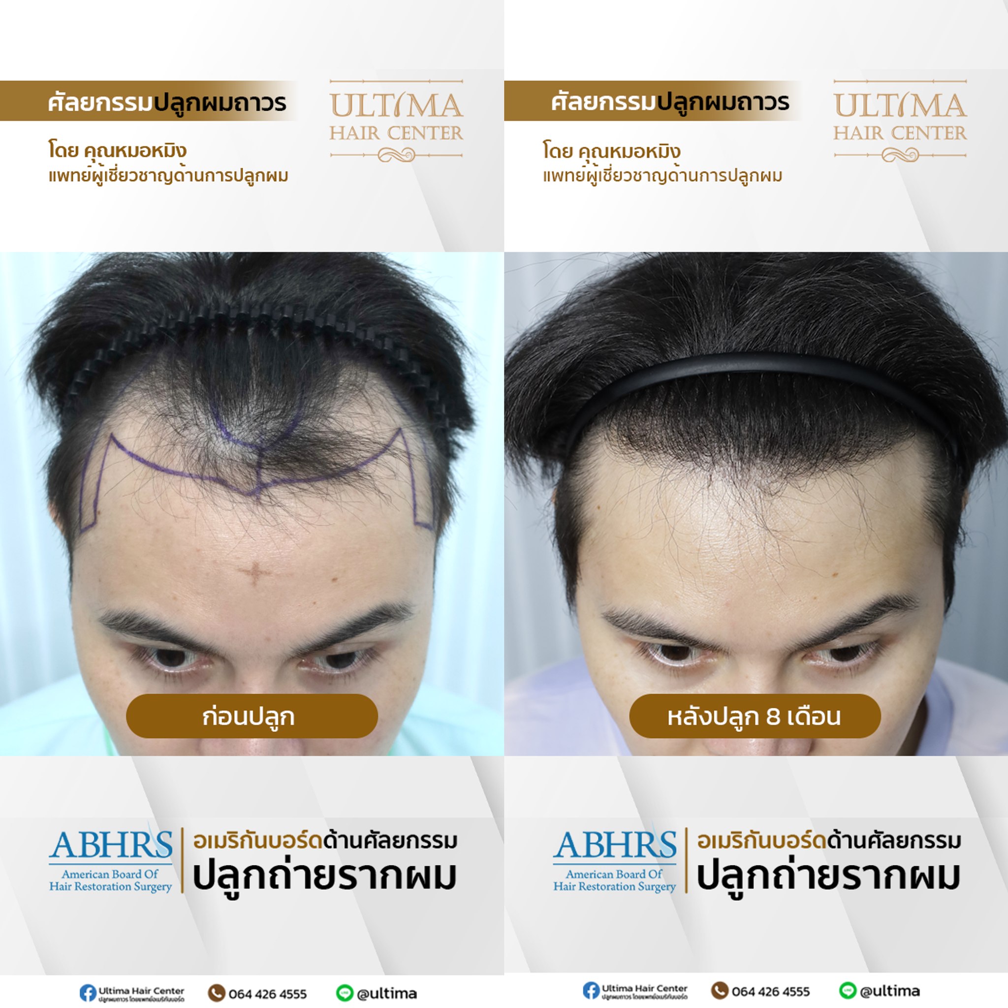แพทย์ปลูกผม ABHRS กรุงเทพ คืออะไร