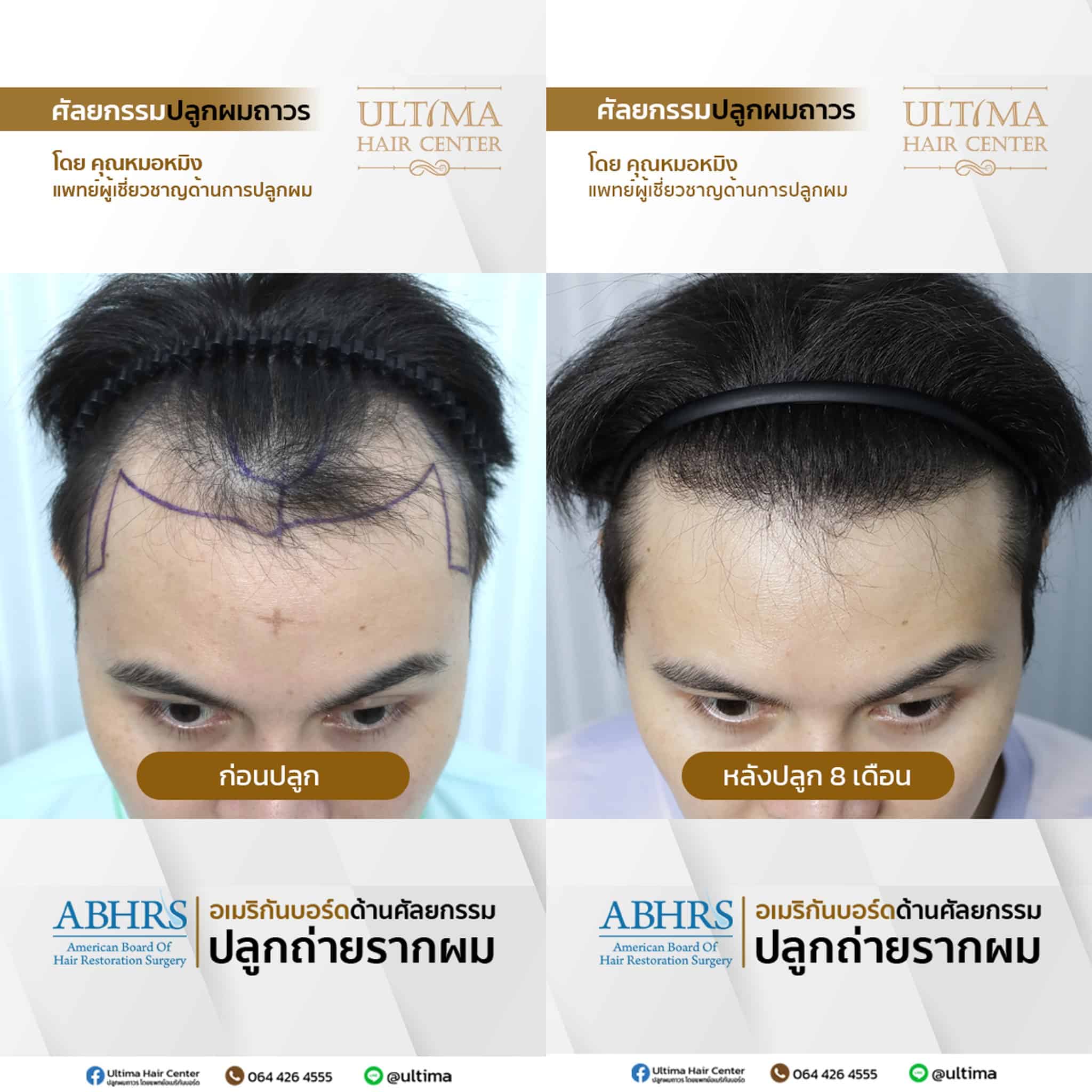 หน้าผากกว้างตั้งแต่เกิด กับ หัวเถิกจากกรรมพันธุ์ ต่างกันอย่างไร