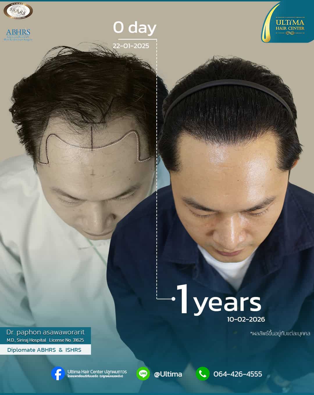 ปลูกผมได้ประโยชน์อย่างไร