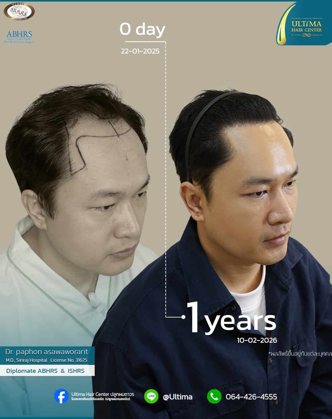 ปลูกผมได้ประโยชน์อย่างไร
