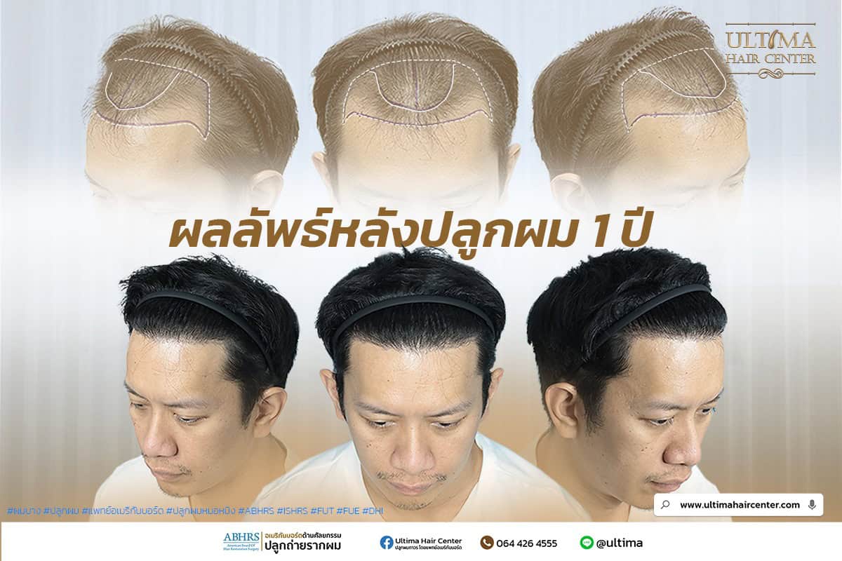 เราสามารถปลูกผมได้กี่ครั้ง