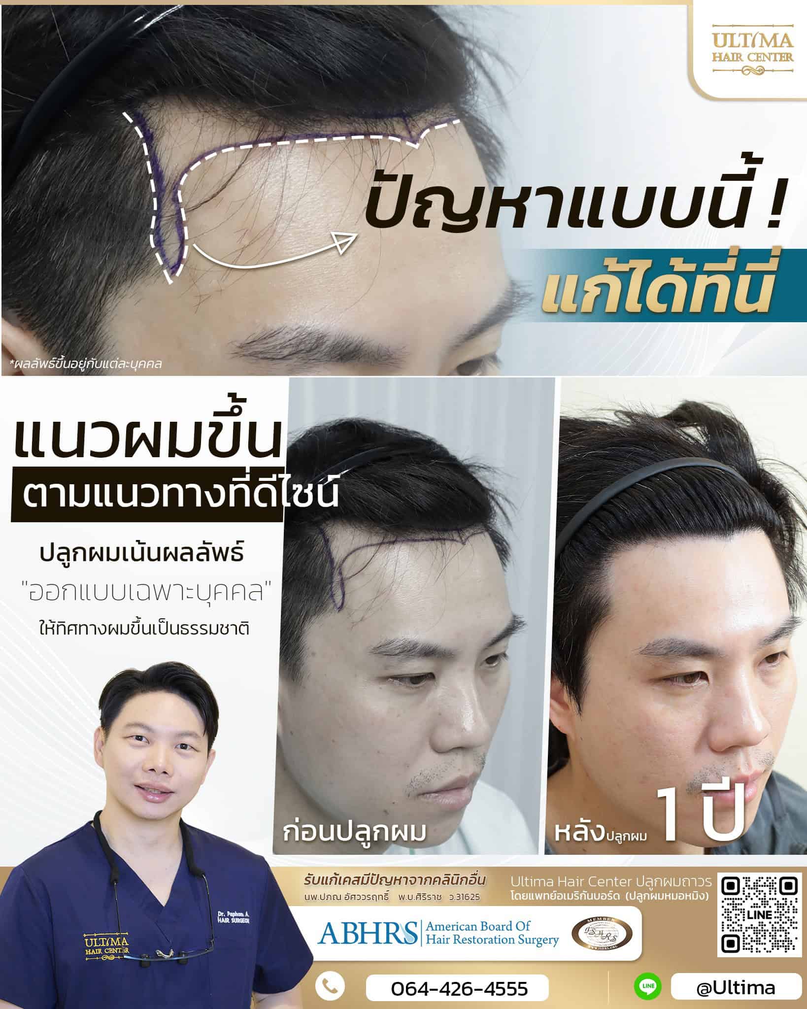 ปลูกผม