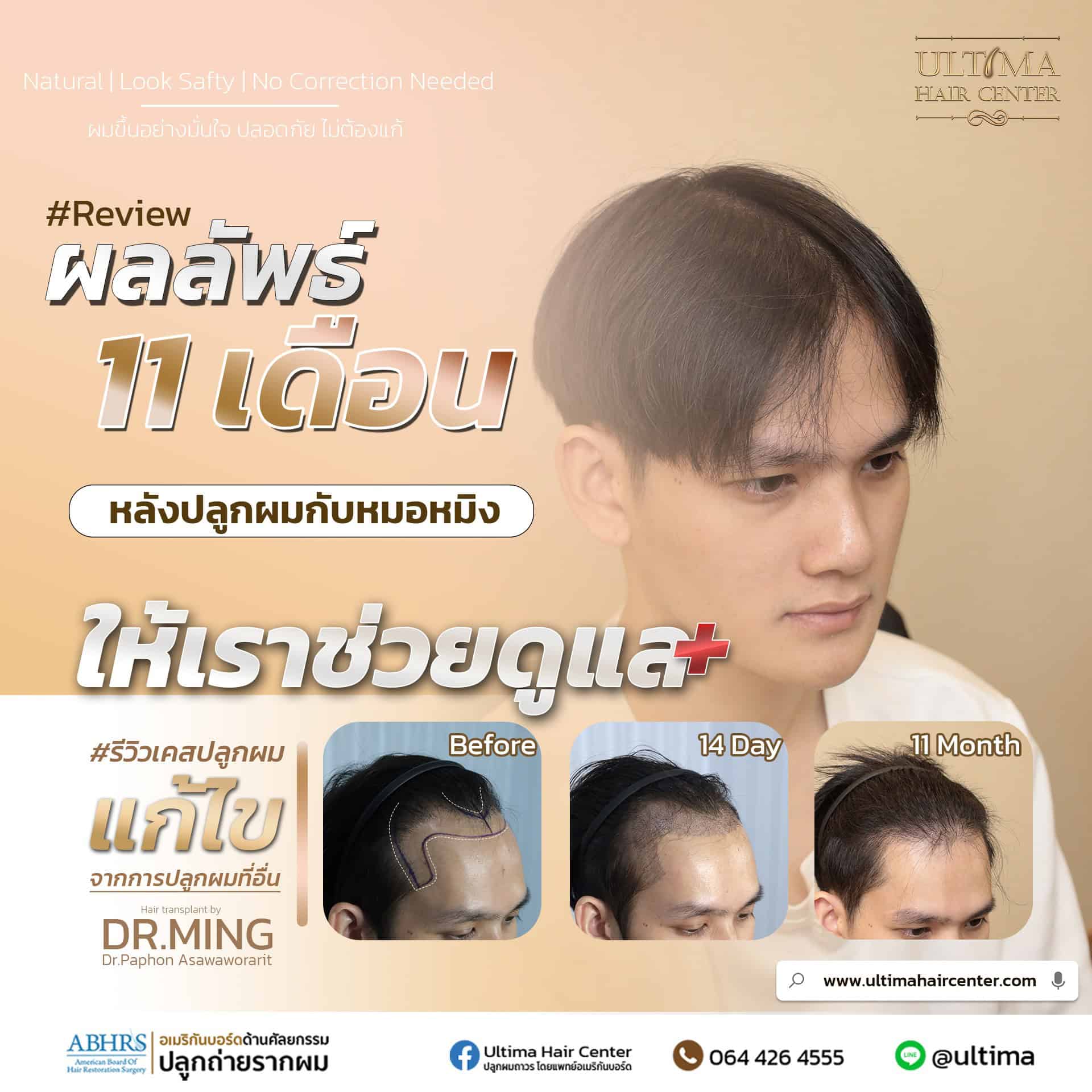 เราสามารถปลูกผมได้กี่ครั้ง