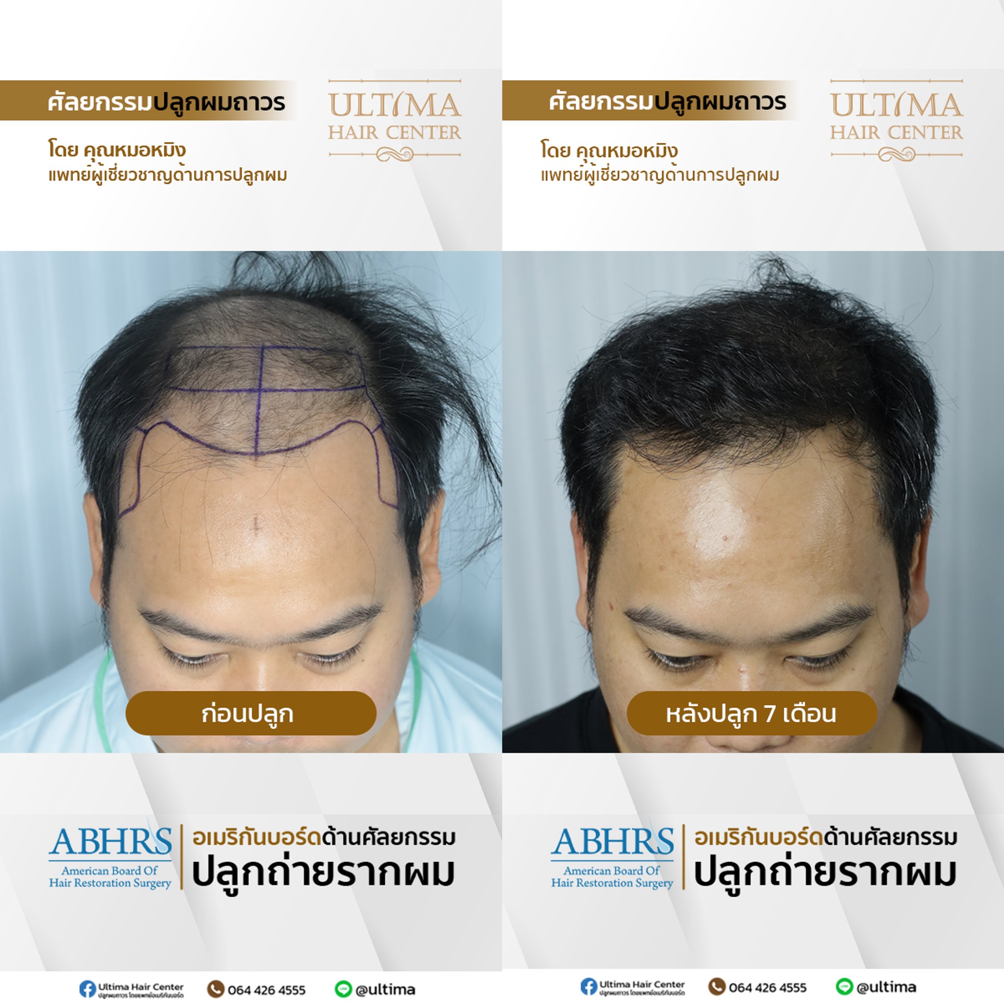 แพทย์ปลูกผม ABHRS กรุงเทพ คืออะไร