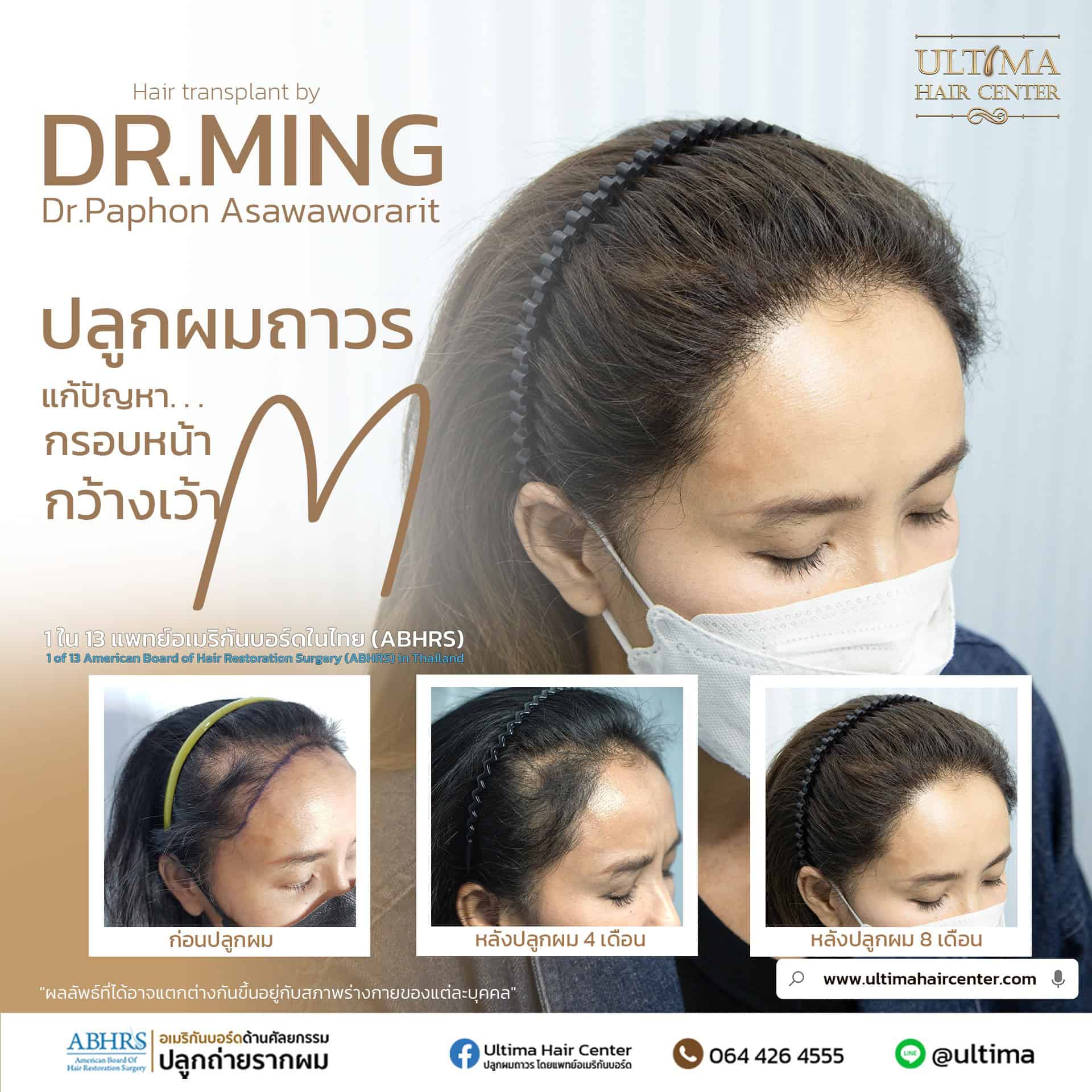 เราสามารถปลูกผมได้กี่ครั้ง