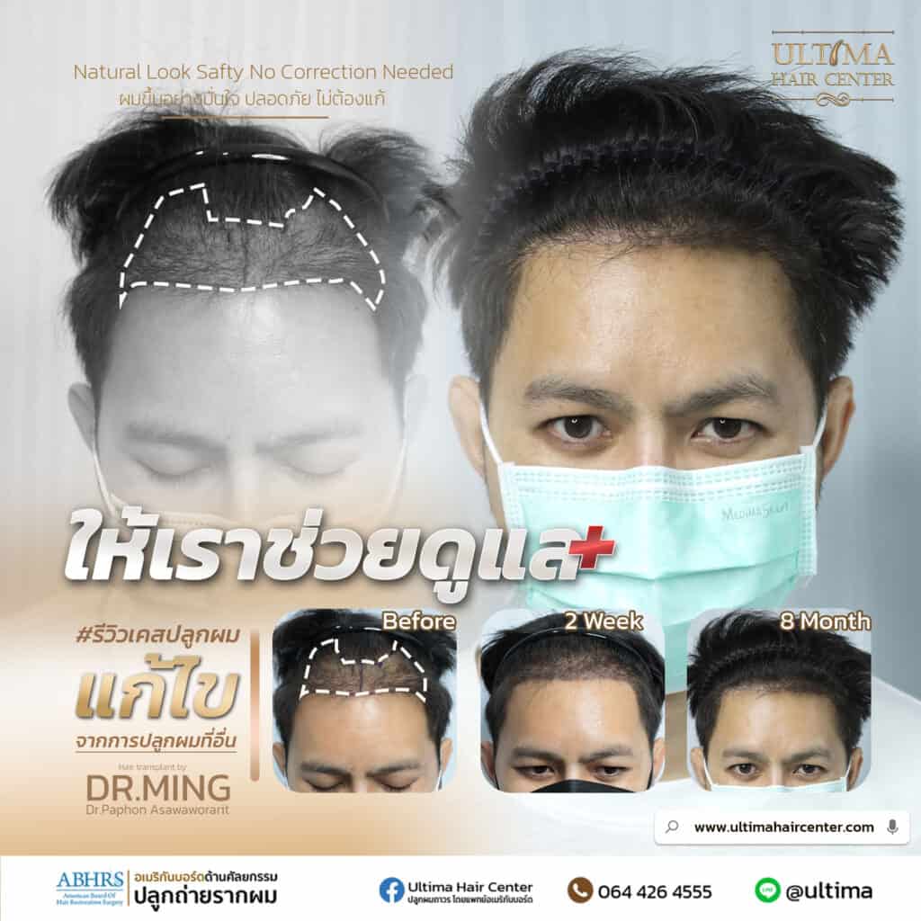 คลินิกปลูกผม กรุงเทพ เลือกอย่างไร