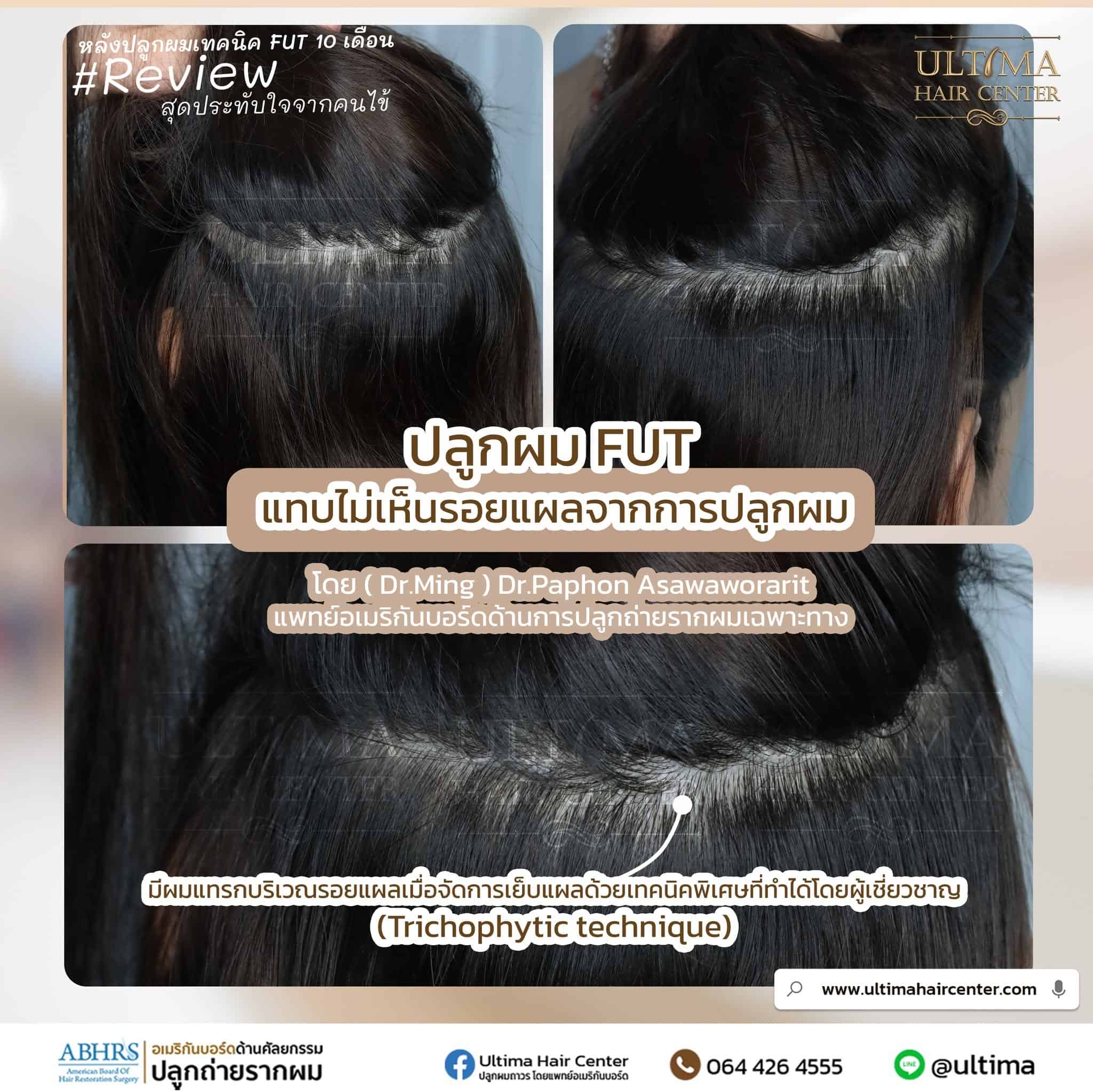 ปลูกผม